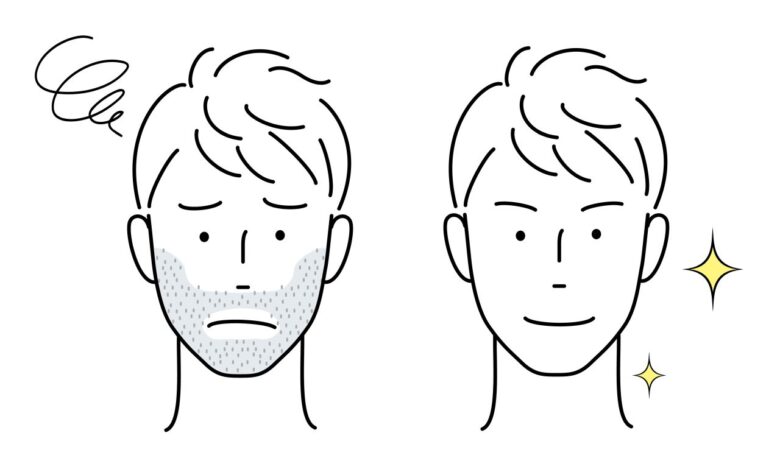 男性 ヒゲ 脱毛